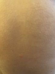 Chicken pox or bed bugs