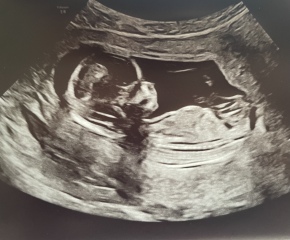 Different baby in each scan?!