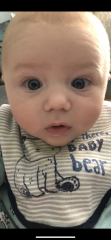 Lines/folds under baby's eye? Picture attached