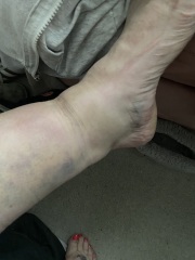 Shin injury