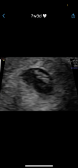 Early pregnancy scan pic…. Boy or girl?