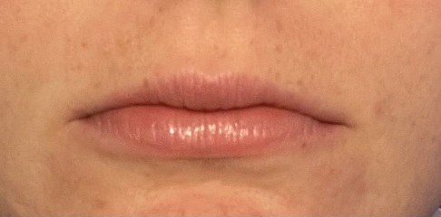 I hate my lips….fillers?