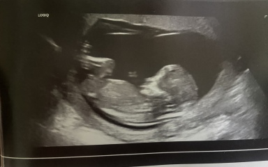 Numb/skull theory predictions at 13 weeks