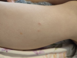 Spots on 5 year olds leg