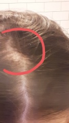 Hair loss? Feeling worried.