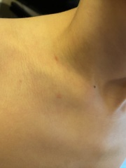 Chicken pox or bed bugs