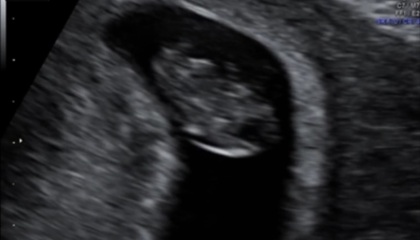 What is this on my baby scan?