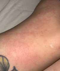 Rash???