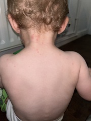 Flat red spots on toddler’s body - anyone know what this is?