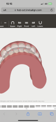 Braces/invisalign