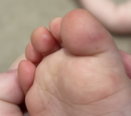Chickenpox or HFM