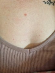 New mole during pregnancy