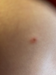 Chicken pox or bed bugs