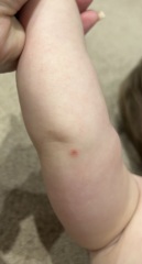 Chickenpox or HFM