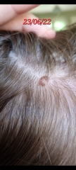 Worried about mole on daughters scalp