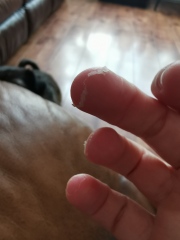 Why is the skin peeling off my fingertips? (pic)