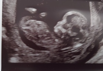 Nub/gender theory guesses - 12 weeks!