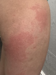 Rash???