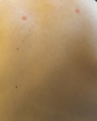 Chicken pox or bed bugs