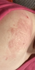Could this be Shingles (pic)?