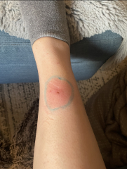 Cellulitis?