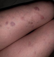 Unexplained bruising