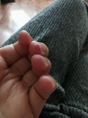Why is the skin peeling off my fingertips? (pic)