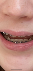 Teeth braces drama