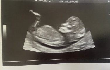 Numb/skull theory predictions at 13 weeks