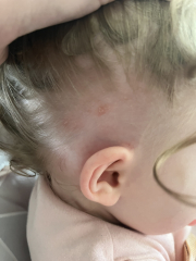 Baby rash & reaction to hydrocortisone