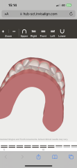 Braces/invisalign