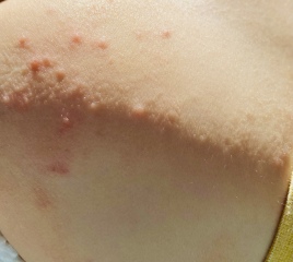 Help with rash - HF&M or Chicken Pox?
