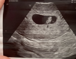 Is my placenta on left or right side?
