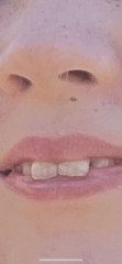 Teeth braces drama