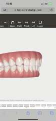 Braces/invisalign