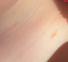 Chickenpox?