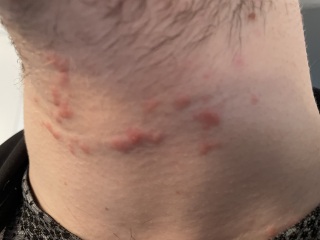 Sudden rash on neck