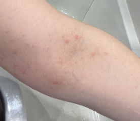 ‘Covid’ rash post vaccines (pics)