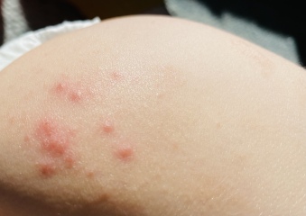 Help with rash - HF&M or Chicken Pox?