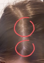Hair loss? Feeling worried.