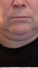 Does anyone want to come on my Upper and Lower Bleph and Necklift journey with me?
