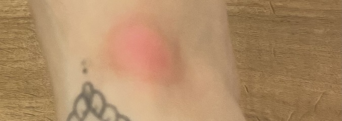 Soft lump on ankle