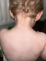 Flat red spots on toddler’s body - anyone know what this is?