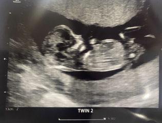 Please help guess the sex… twins 🩷💙
