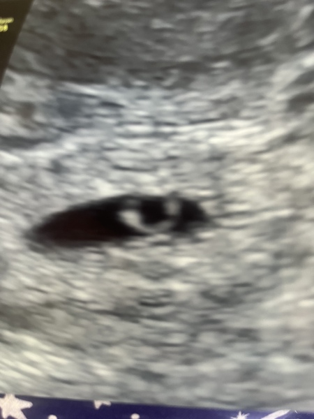 Yolk sac ?