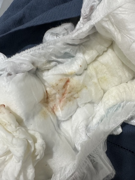 Streak of blood in 13 month old’s nappy - worried!