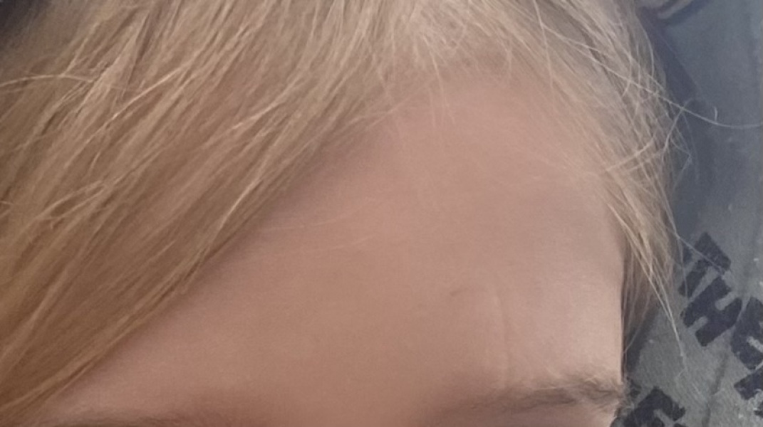 Help! Scar on my LO's face