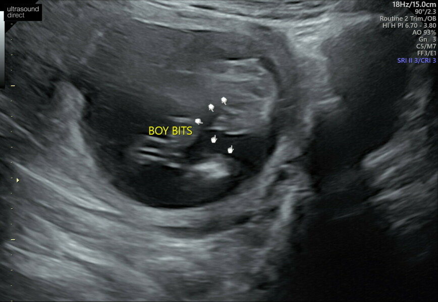 Gender ultrasound doesn't look right