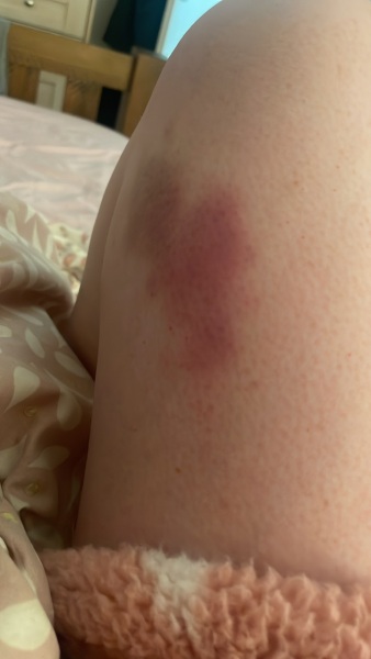 I'm freaking out. Bruising and swollen armpits