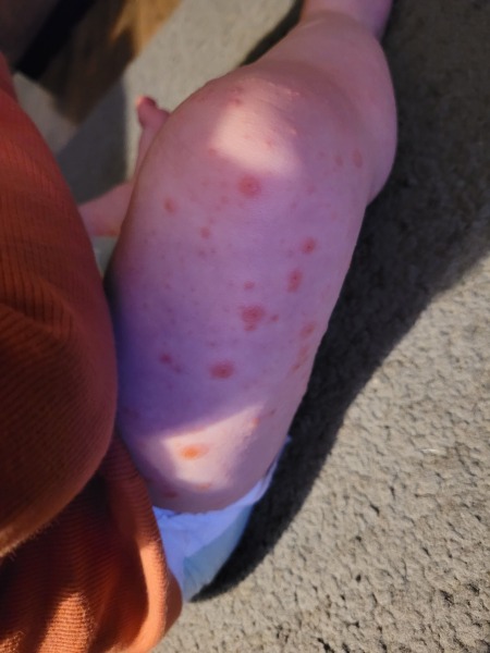 Chicken pox or hand foot and mouth?